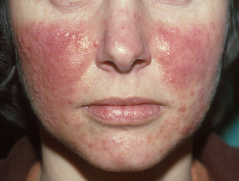 rosacea met bultjes